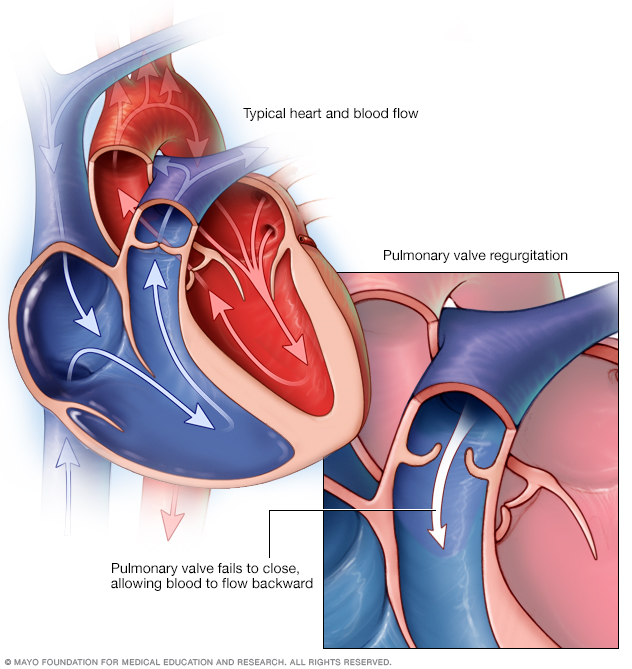 mayo clinic ivcd heart rhythm mayo clinic ivcd heart rhythm