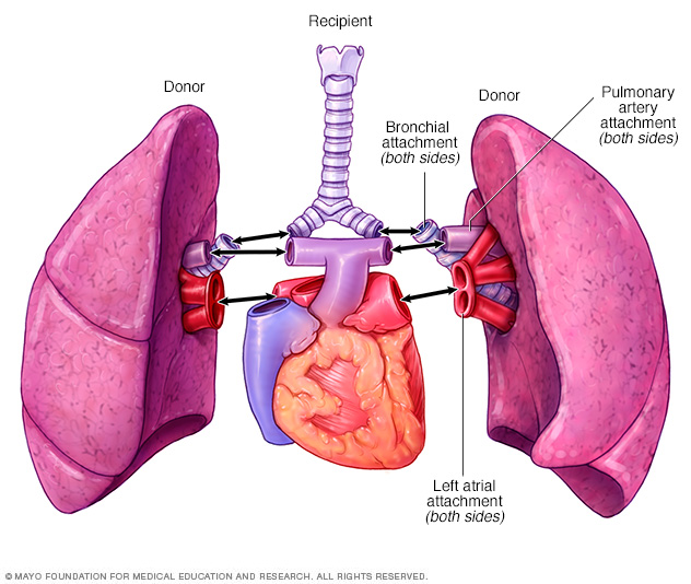 Lung transplant - Mayo Clinic