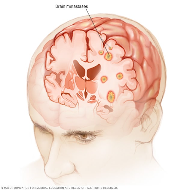 presentation for brain metastasis