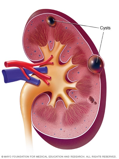 presentation of renal cyst