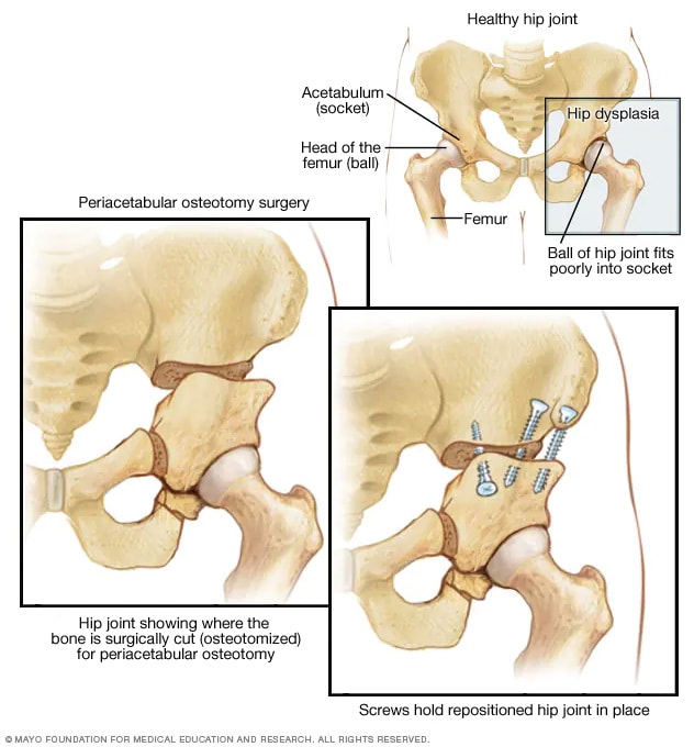 Periacetabular osteotomy Mayo Clinic
