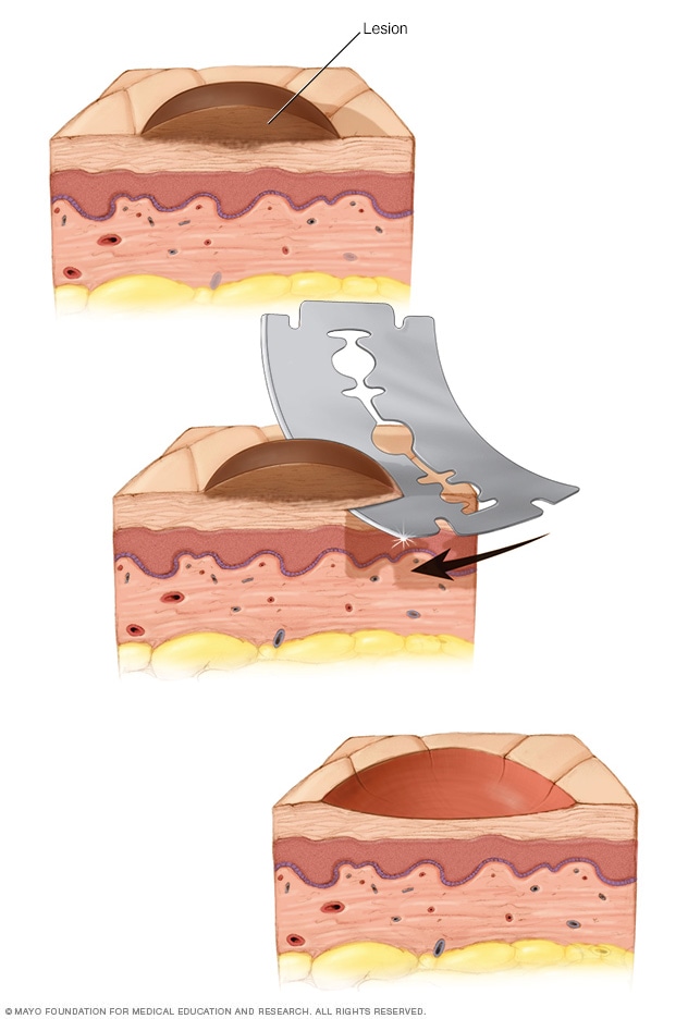 biopsia de piel