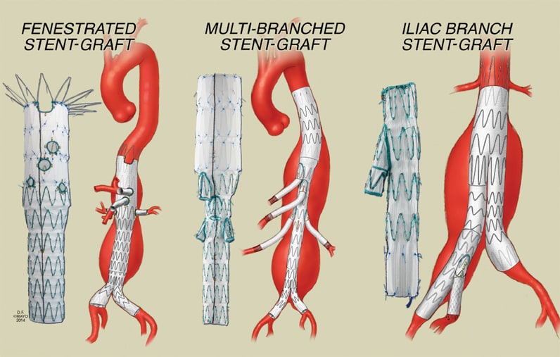 Endovascular repair of complex aortic aneurysms For Medical