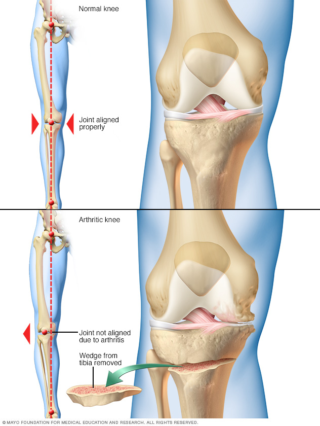 Osteoarthritis Diagnosis and treatment Mayo Clinic