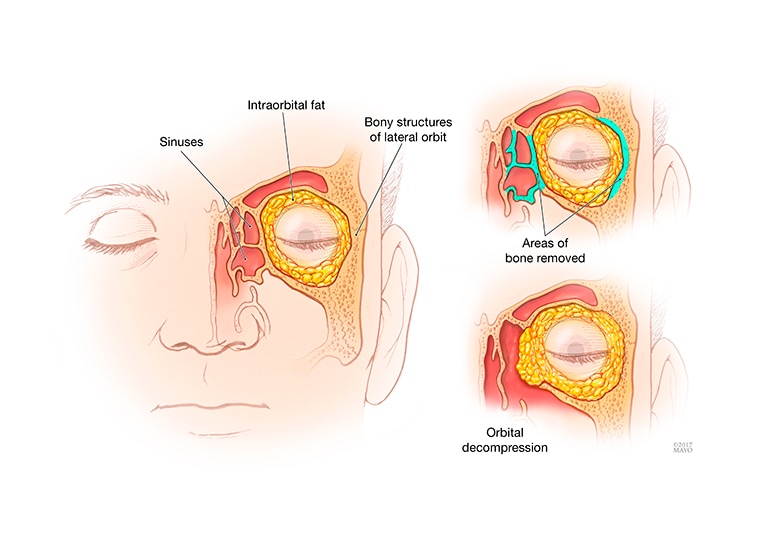 Image result for Thyroid Eye Disease (TED or Graves Eye Disease)