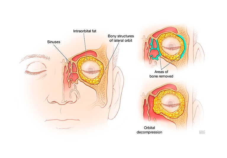 Retinal diseases - Symptoms and causes - Mayo Clinic