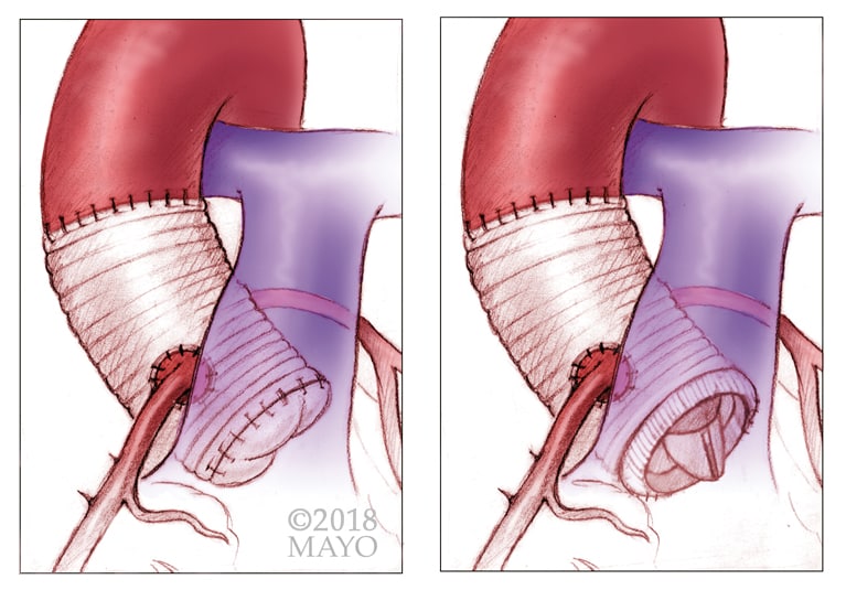 Marfan Syndrome Chart