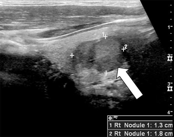 Ultrasound of a 1.8-cm nodule in right thyroid lobe