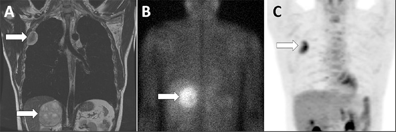 Right adrenal pheochromocytoma and pleural-based nerve sheath tumor