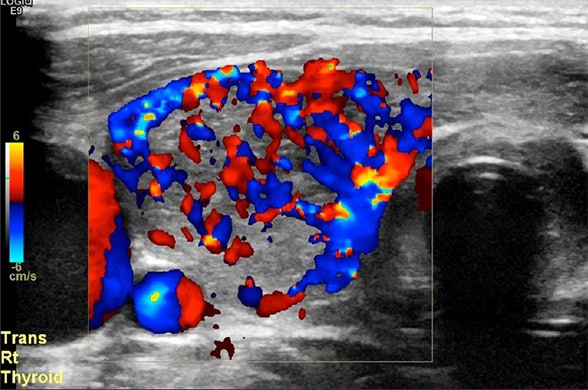 Right midthyroid lobe demonstrating increasing vascularity