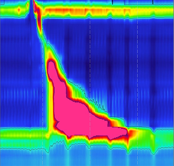 High-resolution manometry showing achalasia type III in an opiate user