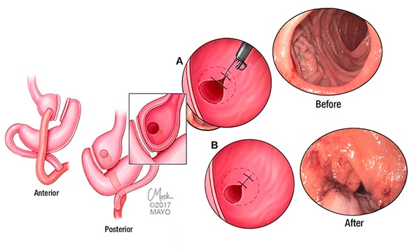 Transoral outlet reduction procedure