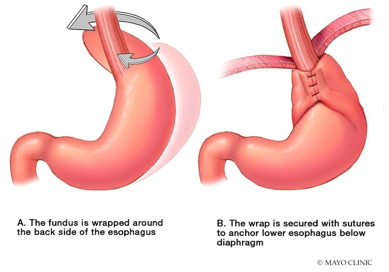 Endoscopic Fundoplication Bridges Gap In Gerd Management Mayo Clinic Endoscopic Fundoplication Bridges Gap In Gerd Management Mayo Clinic