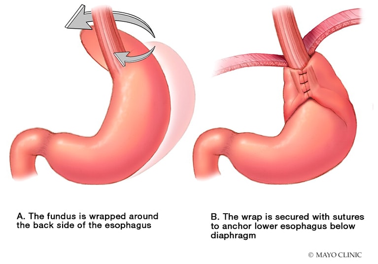 Acid reflux after laparoscopic surgery