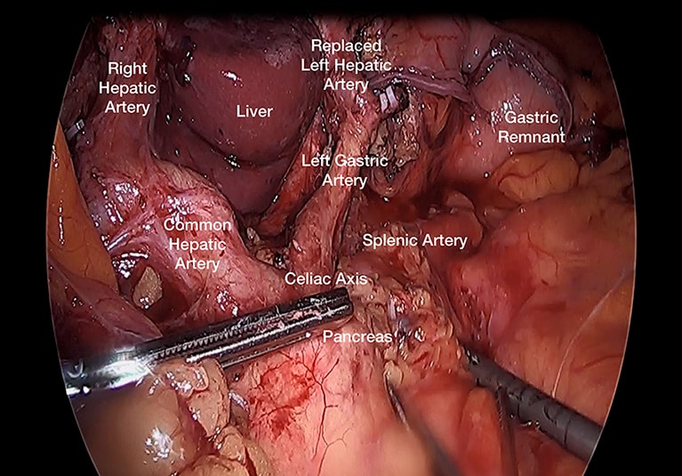abdominal cancer laparoscopy