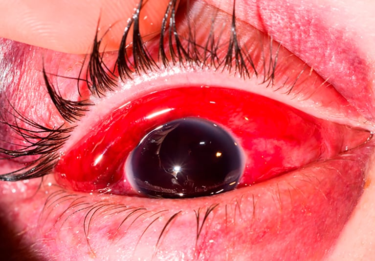 A Blow To The Eye Ocular And Orbital Trauma Mayo Clinic