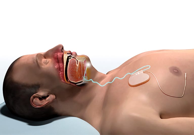 The emerging option of upper airway stimulation therapy - Mayo Clinic