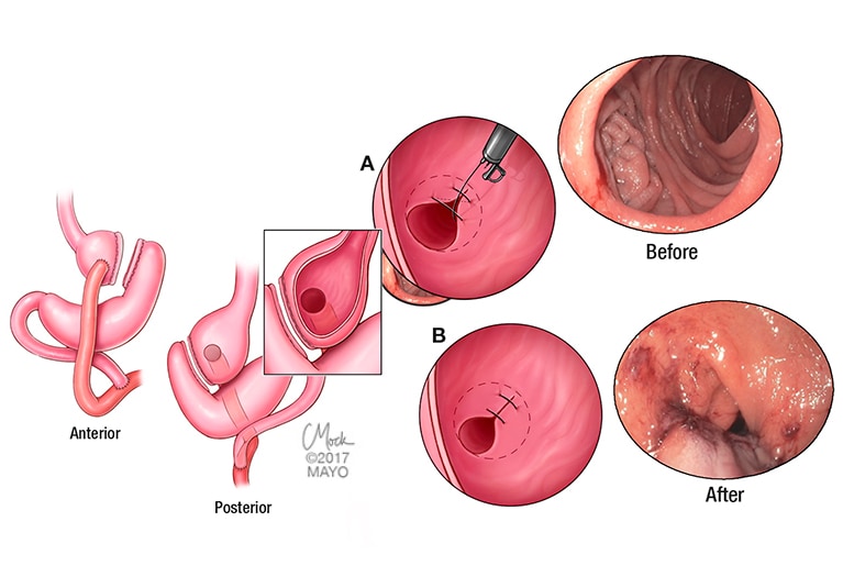 Gastric Sleeve 10 Years Later: Explore Health Outcomes, Insights