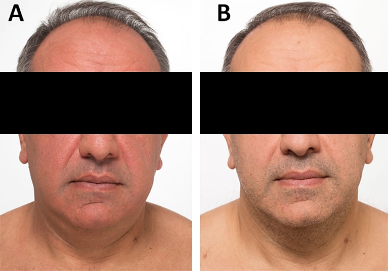 A Flushing Disorder A Case From The Endocrine Teaching Clinics