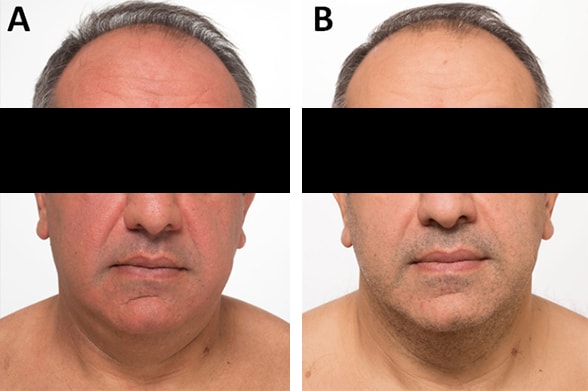 Patient before and after surgery