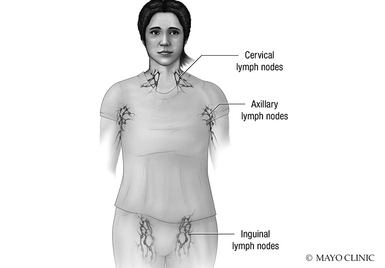 Lymphedema: Diagnosis and treatment - Mayo Clinic