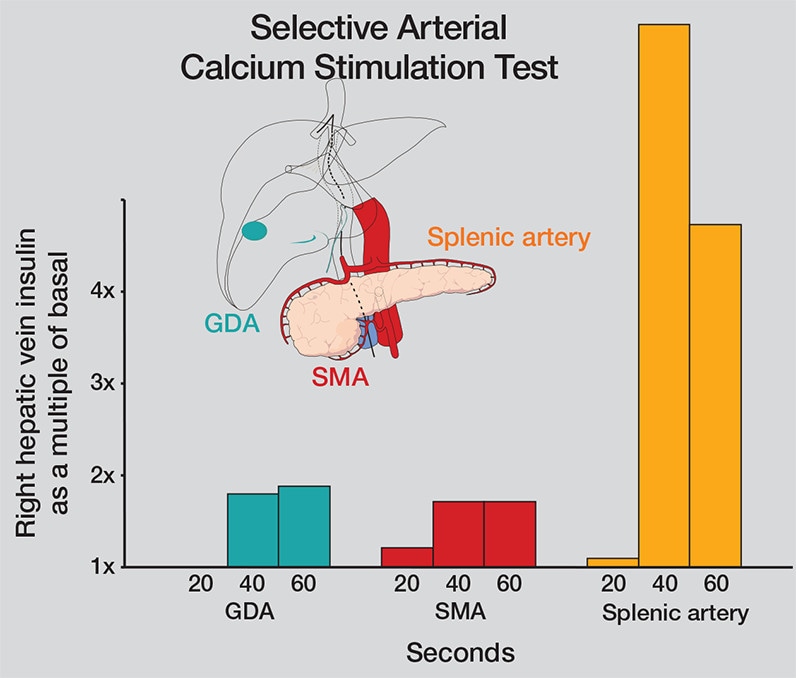 Selective arterial calcium stimulation test results