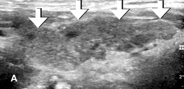 Increased thyroid vascularity
