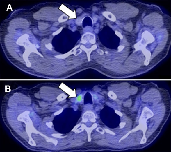 Neck at thyroid gland level pre- and post-surgery