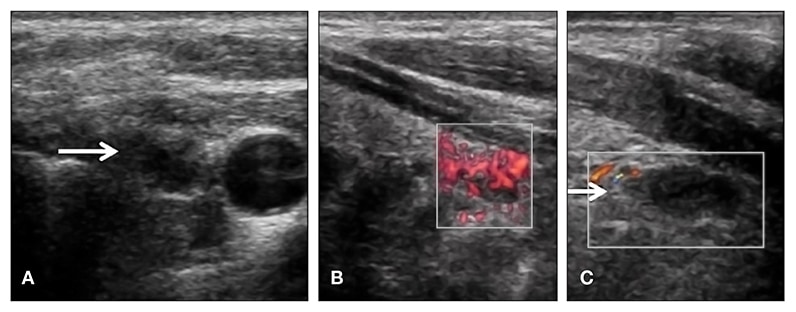 Right inferior parathyroid adenoma