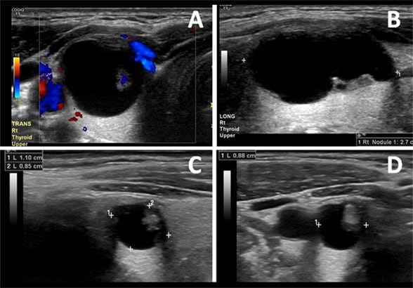 Thyroid cyst before and at follow-up after PEI