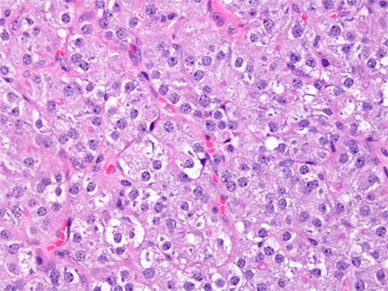 Microscopic appearance of steroid cell tumor