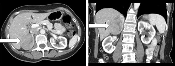  Axial and coronal CT images of right adrenal mass