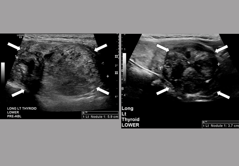 Benign Thyroid Nodules benign-thyroid-nodules