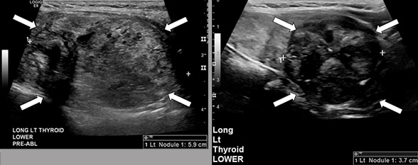 Thyroid nodules before and after RFA