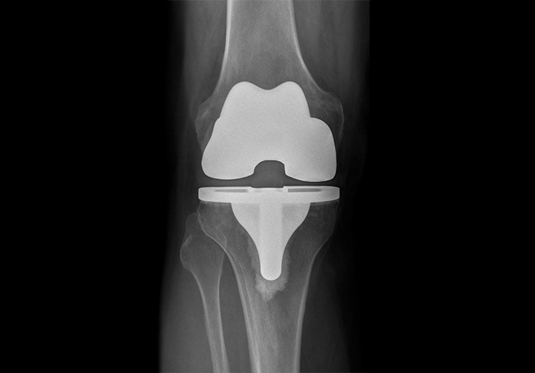 Customized implants for knee replacements - Mayo Clinic