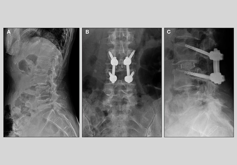 Lumbar fusion shop