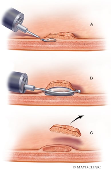 Endoscopic mucosal resection for colorectal polyps