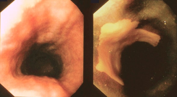 白光内镜检查显示黏膜正常的内镜图像和 Lugol 染色内镜检查显示无染色病变的内镜图像
