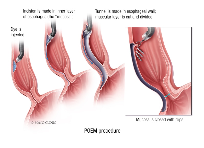 经口内镜食管下括约肌切开术（POEM）