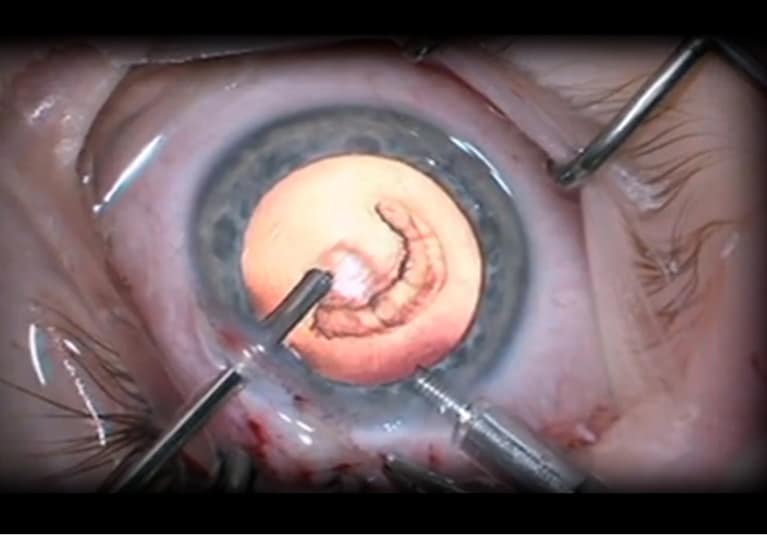 Ophthalmology