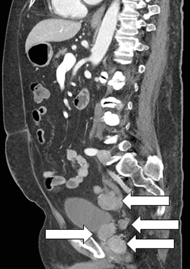 CT scan sagittal image of prostatic mass and multiple metastases