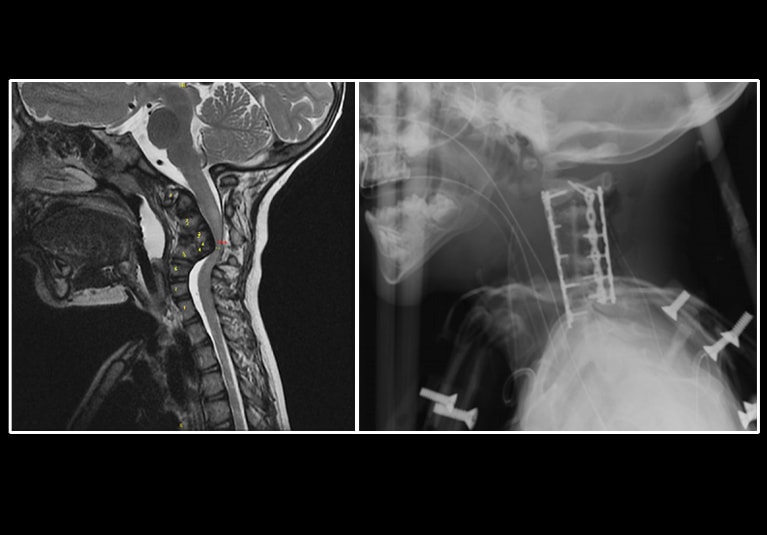 Cervical Spine Surgery