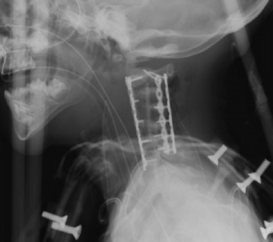 Realineación de la columna vertebral