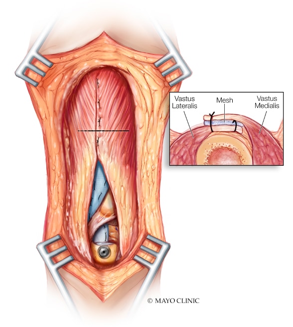 Mesh incorporated with the proximal tissue