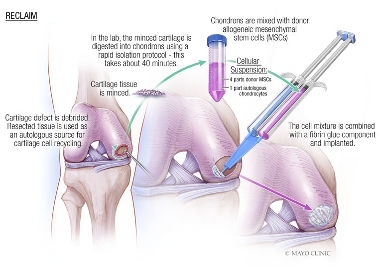 https://www.mayoclinic.org/-/media/kcms/gbs/medical-professionals/images/2018/12/27/13/57/novel-stem-cell-therapy-for-repair-of-knee-767px.jpg