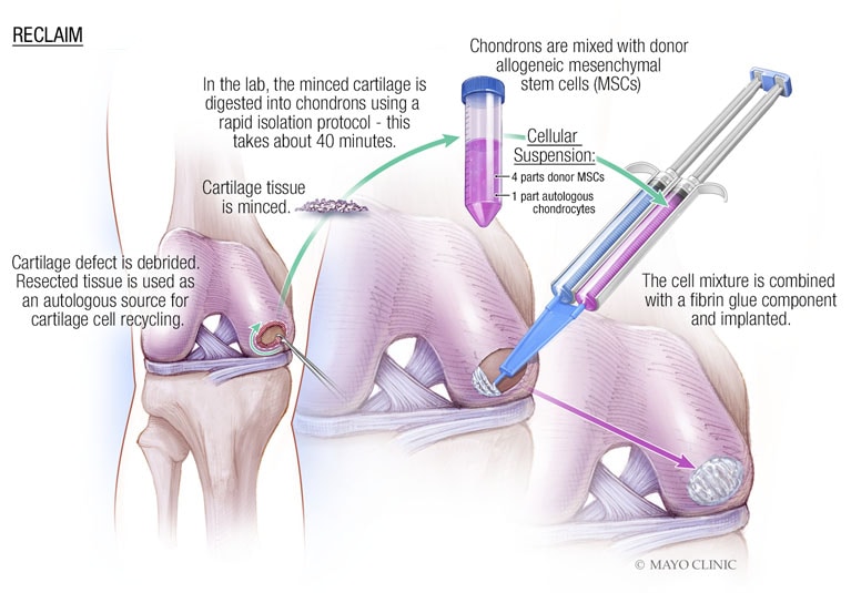 Stem Cells in the Treatment of Disease - NEJM