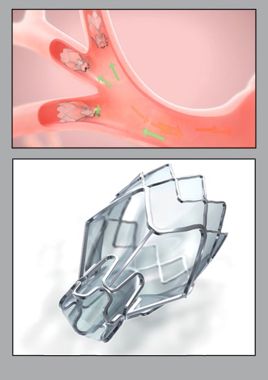 Zephyr Endobronchial Valve System