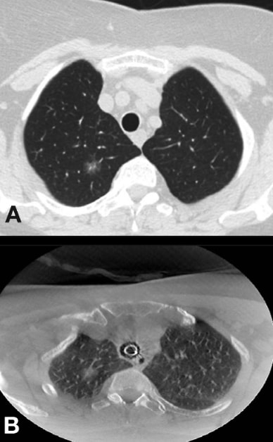 Comparación de TC estándar y CBCT