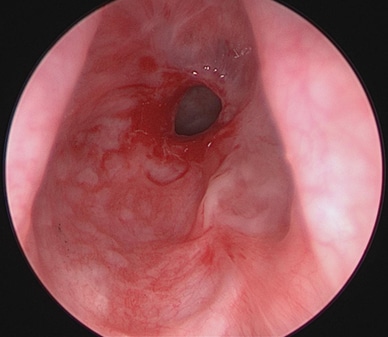 Rhinolaryngoscopy showing ISS