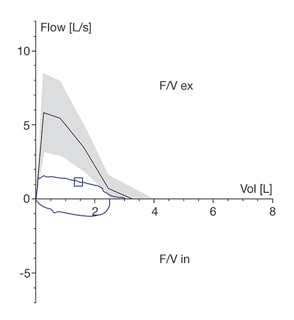 Flow-volume loop of a patient with ISS